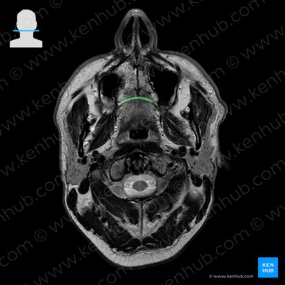 Sutura palatina transversa (Quere Gaumennaht); Bild: 