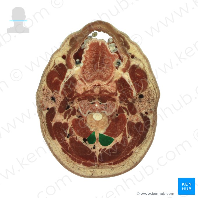 Músculo reto posterior maior da cabeça (Musculus rectus capitis posterior major); Imagem: National Library of Medicine