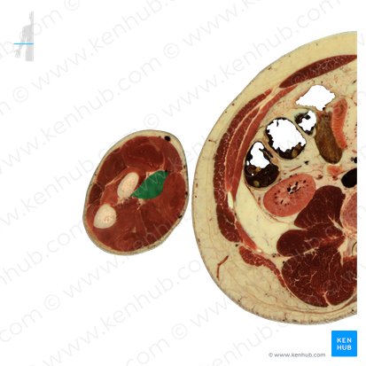 Músculo pronador redondo (Musculus pronator teres); Imagem: National Library of Medicine