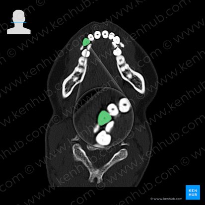 Maxillary right canine tooth (Dens caninus dexter maxillaris); Image: 