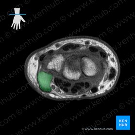 Pisiform bone (Os pisiforme); Image: 