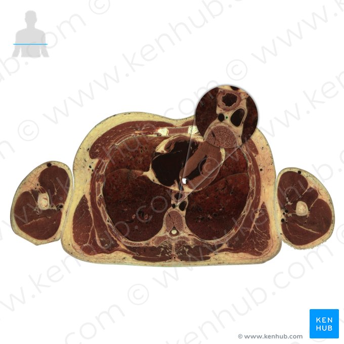 Thoracic duct (Ductus thoracicus); Image: National Library of Medicine