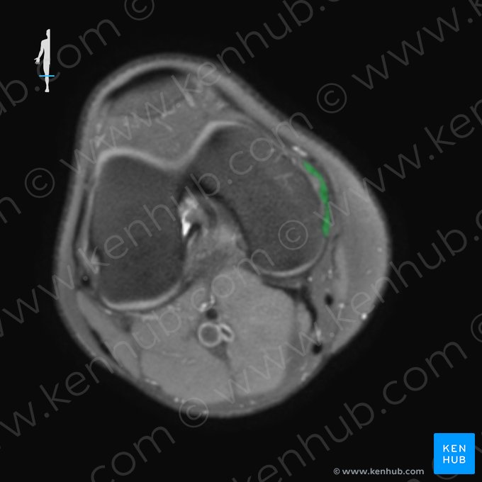 Ligamento colateral tibial de la articulación de la rodilla (Ligamentum collaterale tibiale genus); Imagen: 
