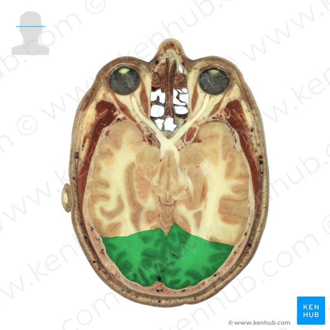 Occipital lobe (Lobus occipitalis); Image: National Library of Medicine