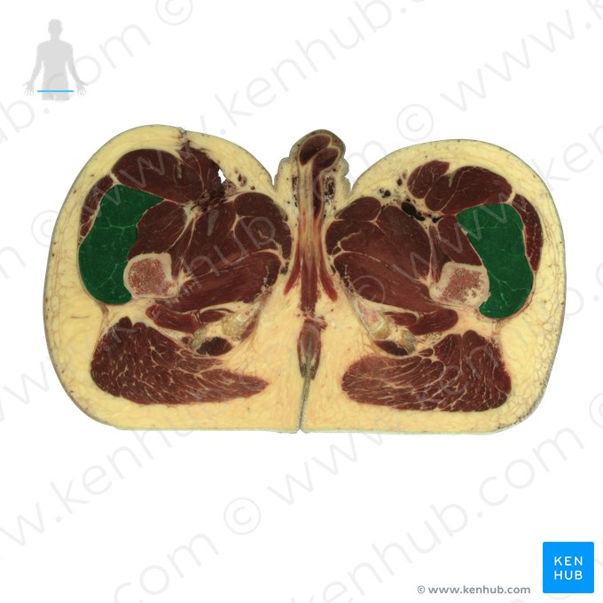 Vastus lateralis muscle (Musculus vastus lateralis); Image: National Library of Medicine