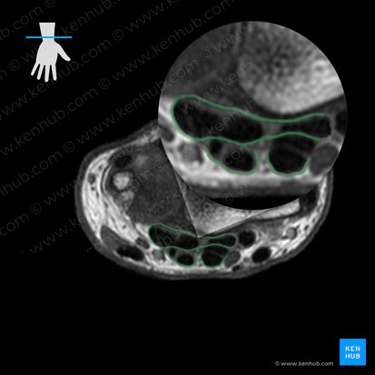 Common flexor sheath of hand (Vagina communis tendinum musculorum flexorum); Image: 