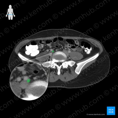 Arteria ilíaca interna (Arteria iliaca interna); Imagen: 