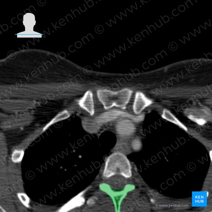 Arch of vertebra T3 (Arcus vertebrae T3); Image: 