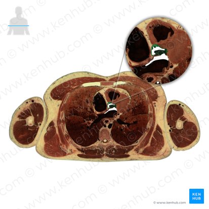 Aorta ascendens (Aufsteigende Aorta); Bild: National Library of Medicine