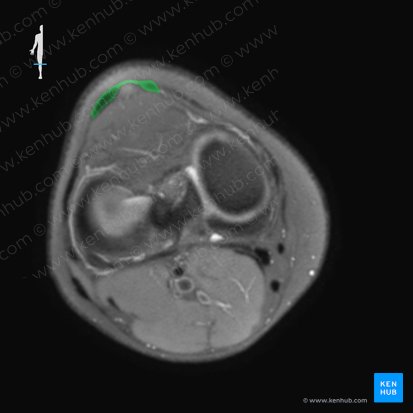 Ligamento patelar (Ligamentum patellae); Imagen: 