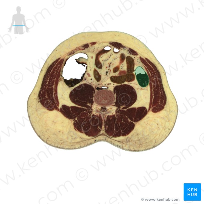 Cólon descendente (Colon descendens); Imagem: National Library of Medicine