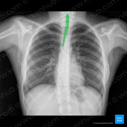 Trachea (Luftröhre); Bild: 