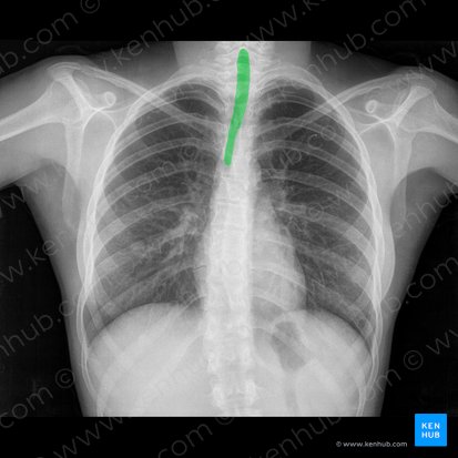 Normal chest x-ray: Anatomy tutorial