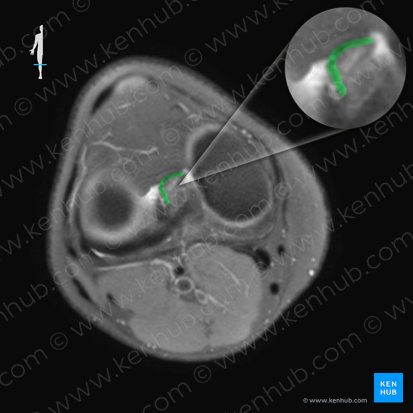 Ligamento cruzado anterior (Ligamentum cruciatum anterius); Imagen: 