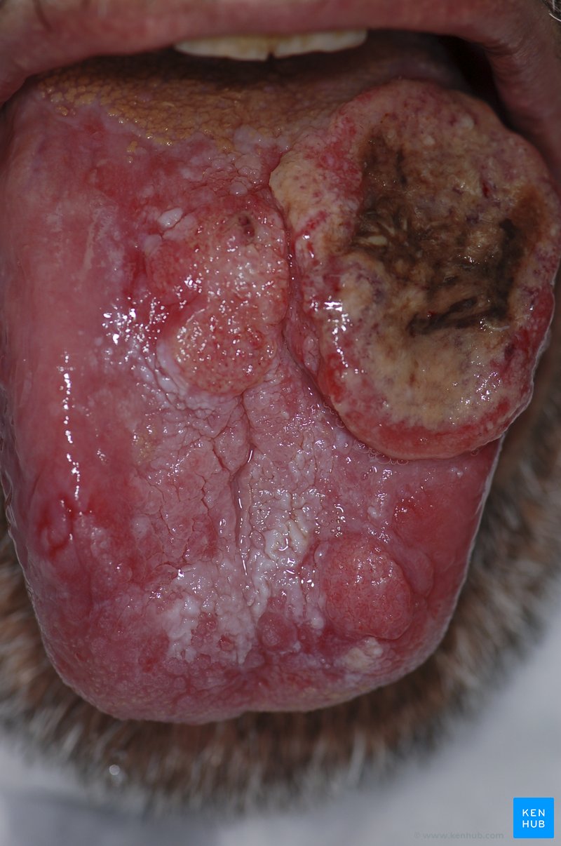 Tongue Cancer