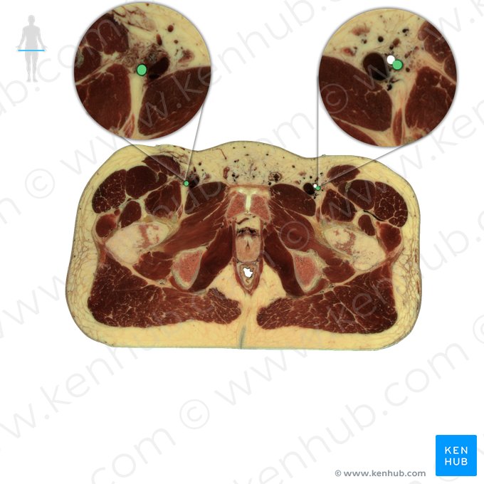 Artéria femoral profunda (Arteria profunda femoris); Imagem: National Library of Medicine