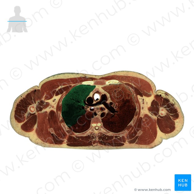 Lobus superior pulmonis dextri (Oberlappen der rechten Lunge); Bild: National Library of Medicine