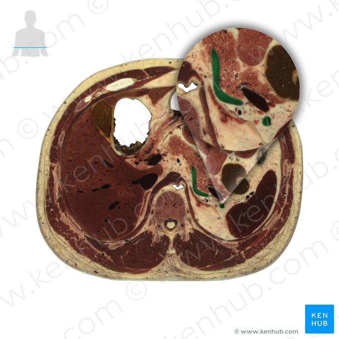 Artéria esplênica (Arteria splenica); Imagem: National Library of Medicine