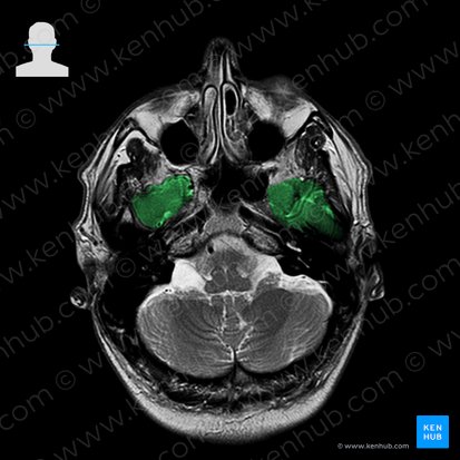 Pars squamosa ossis temporalis (Schuppenteil des Schläfenbeins); Bild: 