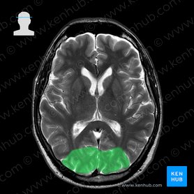 Brain Mri How To Read Mri Brain Scan Kenhub