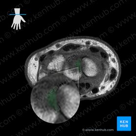 Interosseous intercarpal ligaments (Ligamenta intercarpea interossea); Image: 