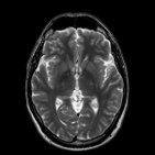 Normal brain MRI