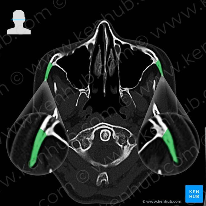 Os zygomaticum (Jochbein); Bild: 