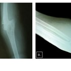 Clinical case: Brachial artery injury