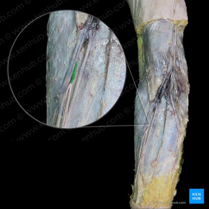 Nervus cutaneus lateralis antebrachii (Seitlicher Hautnerv des Unterarms); Bild: 