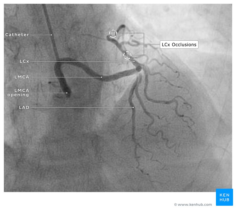 Angiogram of an abnormal left coronary artery
