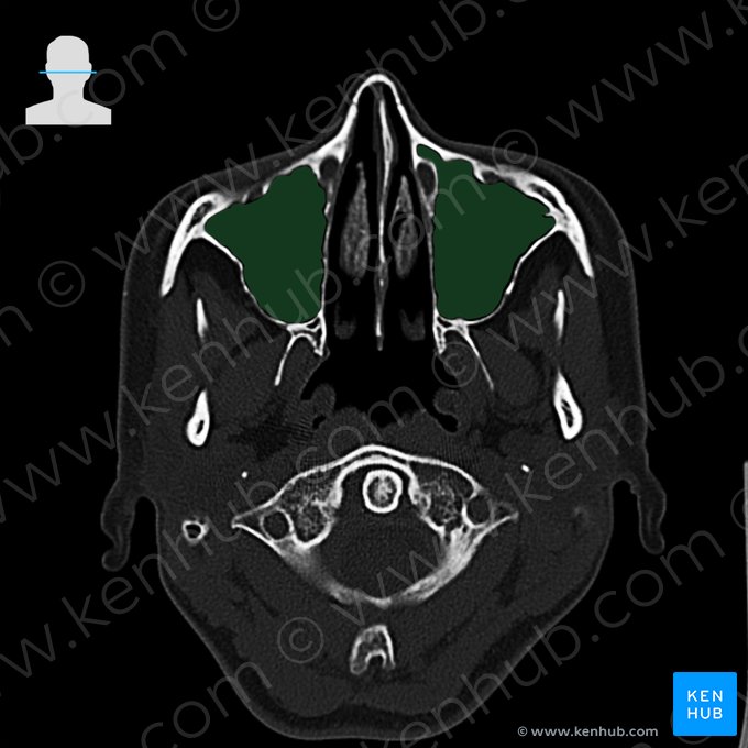 Seno maxilar (Sinus maxillaris); Imagen: 