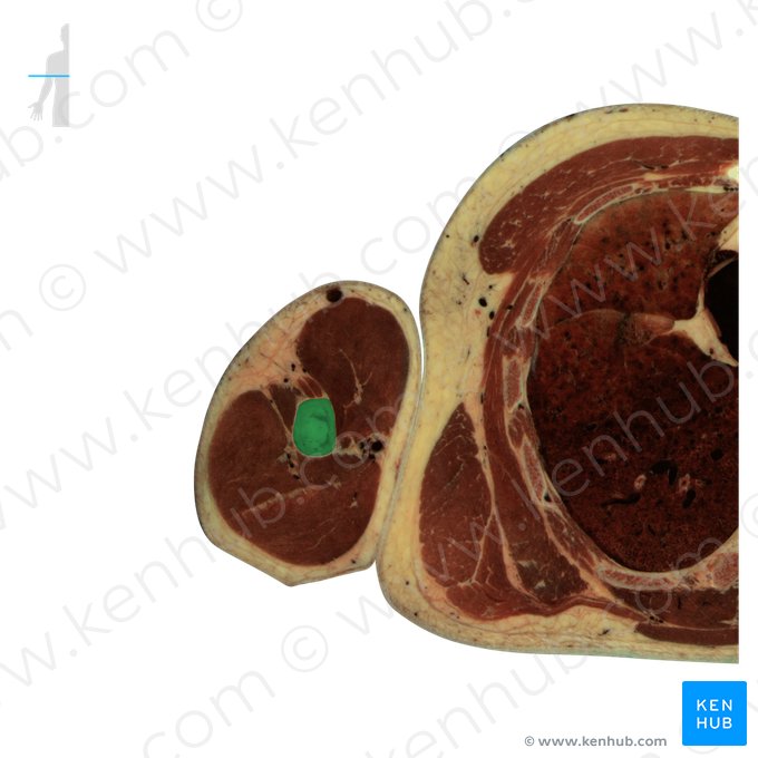 Úmero (Humerus); Imagem: National Library of Medicine