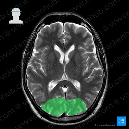 Occipital lobe (Lobus occipitalis); Image: 