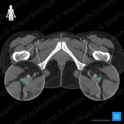 Deep femoral artery (Arteria profunda femoris); Image: 