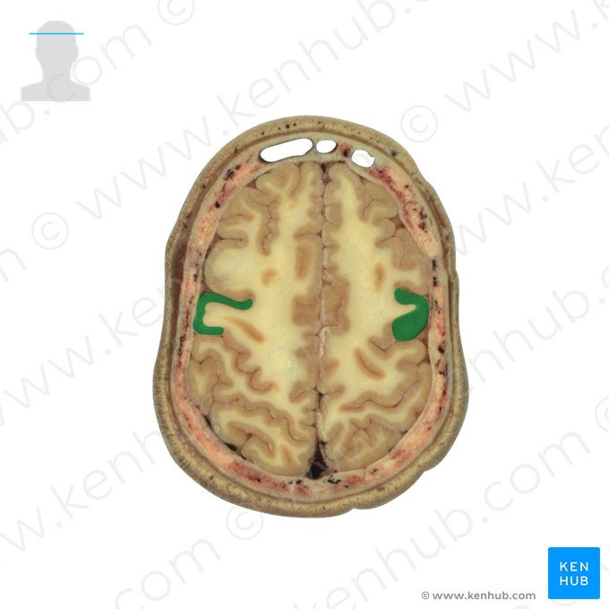 Gyrus precentralis (Vordere Zentralwindung); Bild: National Library of Medicine