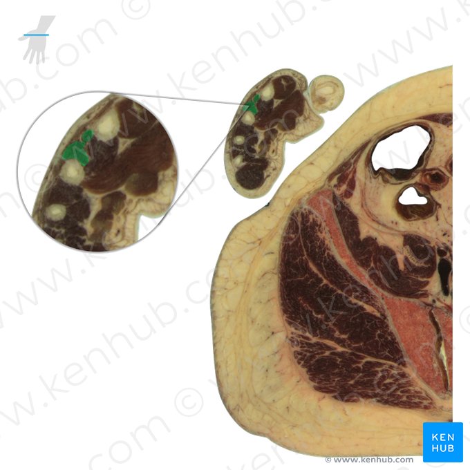 2° músculo interósseo dorsal (Musculus interosseus dorsalis 2 manus); Imagem: National Library of Medicine