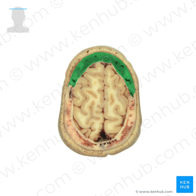 Osso frontal (Os frontale); Imagem: National Library of Medicine