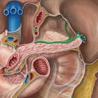 Clinical case: Splenic artery rupture