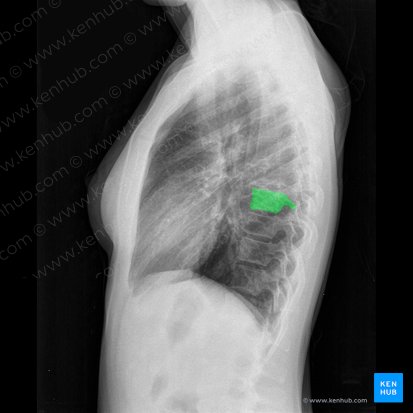 Vértebra T7 (Vertebra T7); Imagem: 