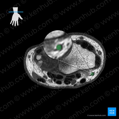 Radial artery (Arteria radialis); Image: 