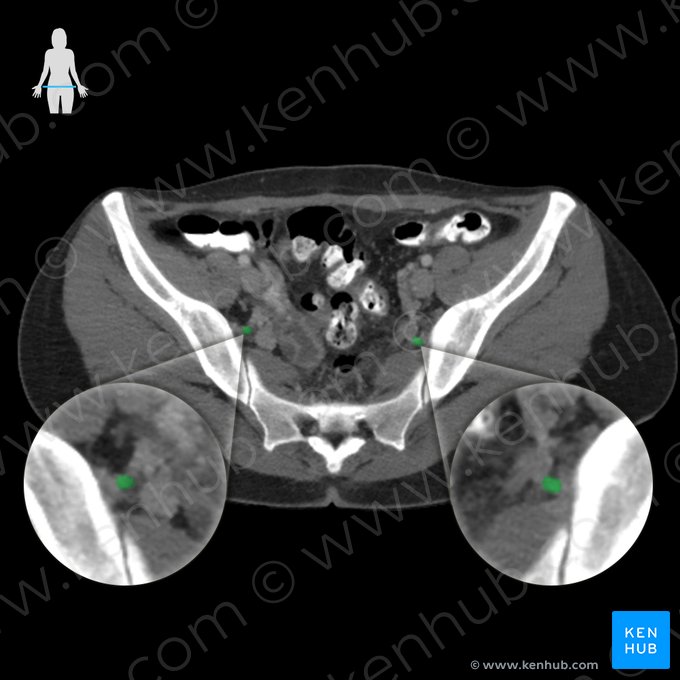Arteria glutea superior (Obere Gesäßarterie); Bild: 