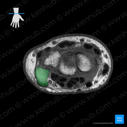 Pisiform bone (Os pisiforme); Image: 