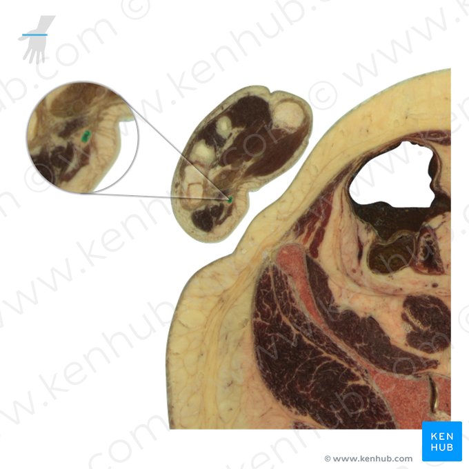 Ulnar artery (Arteria ulnaris); Image: National Library of Medicine