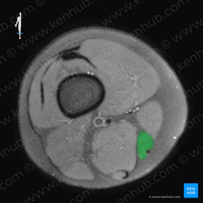 Musculus gracilis (Schlanker Muskel); Bild: 