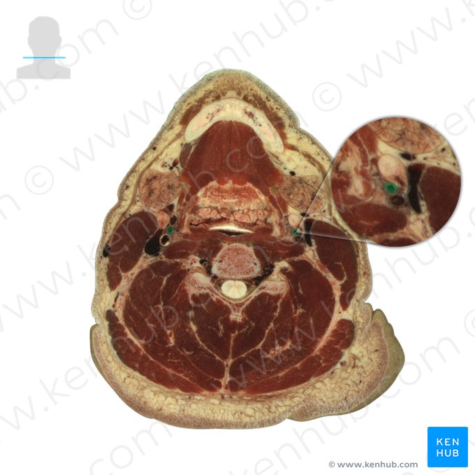 Arteria carotis externa (Äußere Halsschlagader); Bild: National Library of Medicine
