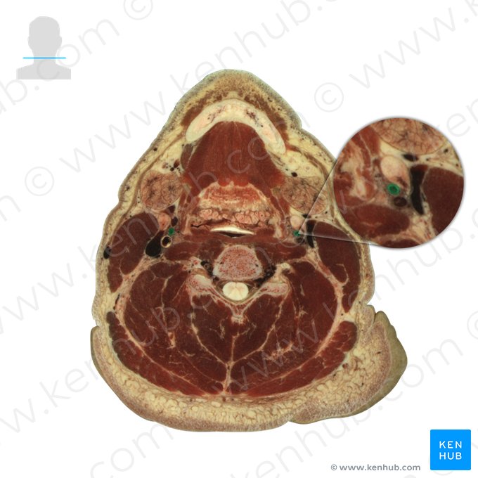 External carotid artery (Arteria carotis externa); Image: National Library of Medicine