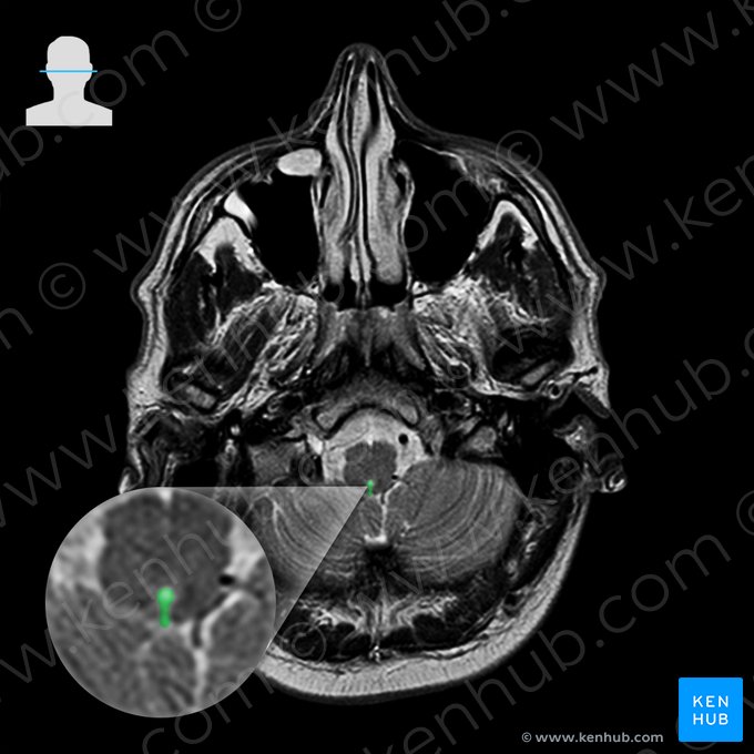 Median aperture of fourth ventricle (Apertura mediana ventriculi quarti); Image: 