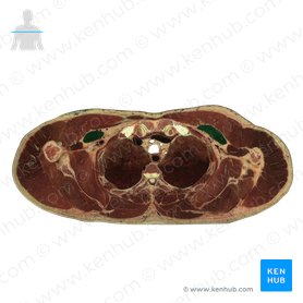 Pectoralis minor muscle (Musculus pectoralis minor); Image: National Library of Medicine