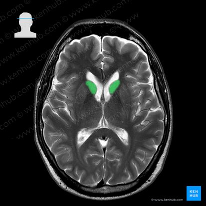 Head of caudate nucleus (Caput nuclei caudati); Image: 