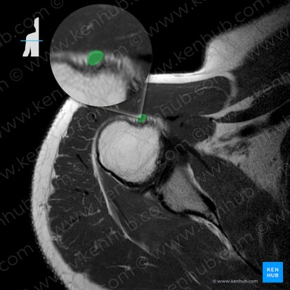 Tendón de la cabeza larga del músculo bíceps braquial (Tendo capitis longi musculi bicipitis brachii); Imagen: 